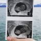 miscarriage, miscarried, ultrasound