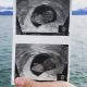 miscarriage, miscarried, ultrasound