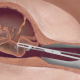 abortion, Live Action, prenatal diagnosis, kansas, late abortion, abortion, D&E