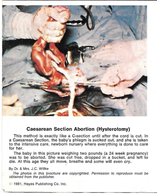 Image: Hysterotomy abortion a (Image: pamphlet Life or Death Hayes Publishing)