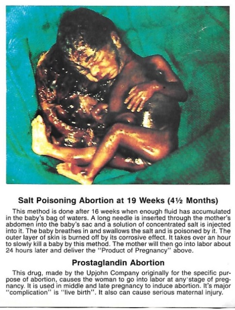 Prostaglandin or Saline abortion Image Hayes Publishing