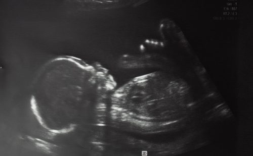 ‘Hope in action’: Indiana sees first successful in-utero surgery for spina bifida