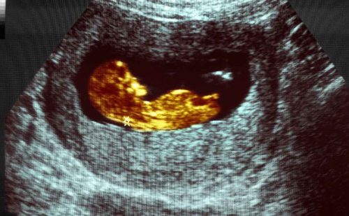 Mom said docs gave more info about abortion than son’s Down syndrome after diagnosis