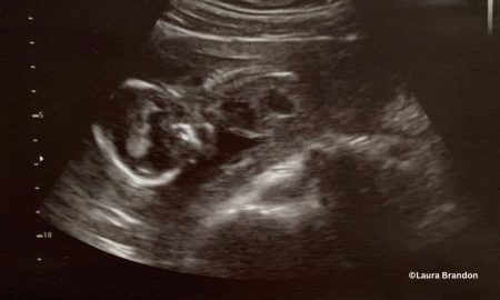 abortion pill, abortion survivor, abortion