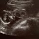 abortion pill, abortion survivor, abortion