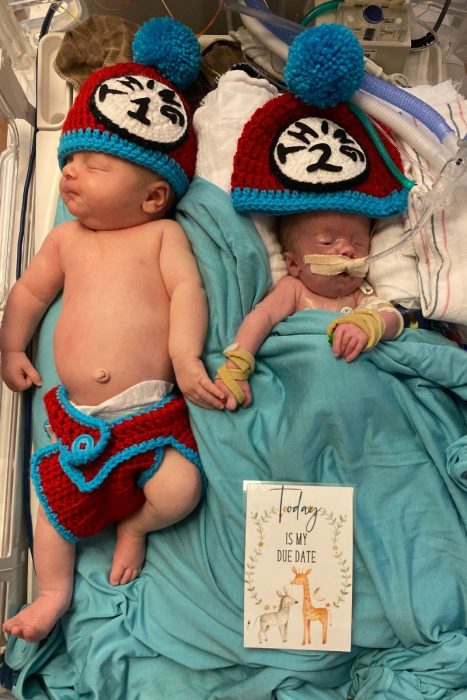 Twins, trisomy 18, abortion