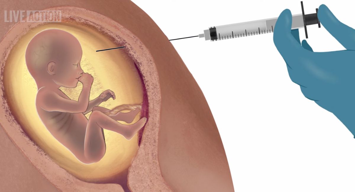 third-trimester abortion, abortion