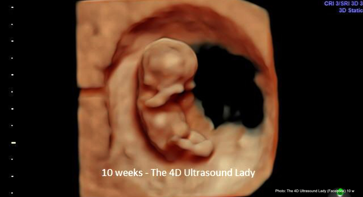 abortion pill reversal