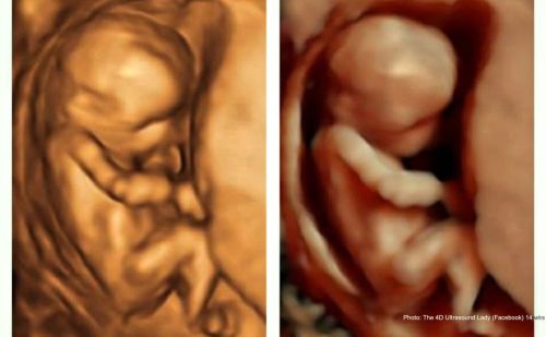 Prenatal development bill heads to Indiana governor’s desk
