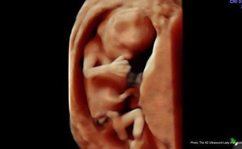 Student who voiced concerns about viewing D&E abortion sues college for degree sabotage