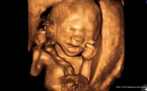 Late-term abortionist’s document: Carrying to term safer for women than abortion at 18+ weeks