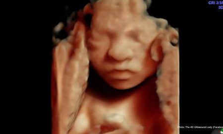abortion