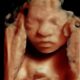 abortion