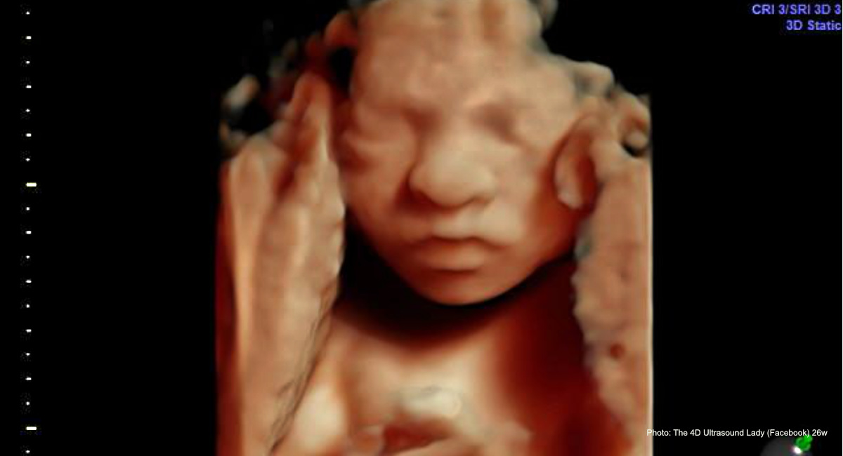 abortion