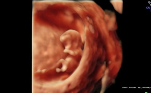 FACT CHECK: Is South Carolina’s pro-life law to blame for denial of a post-miscarriage D&C?