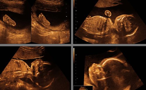 Abortionist grieves deaths of her own quadruplets… two of whom died by her choice