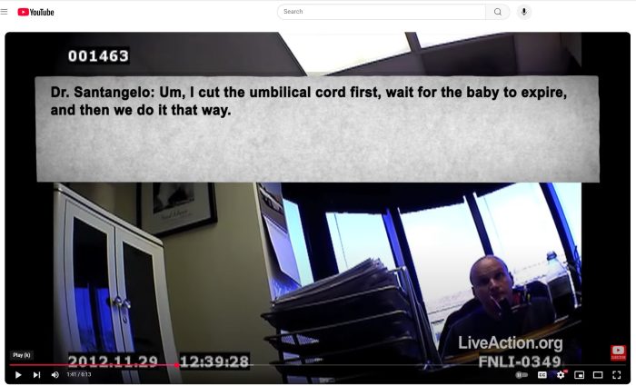 Santangelo late term abortionist cuts cord to kill baby umbilical cord transection